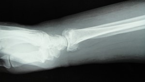 成人前腕骨両骨骨折 (2)